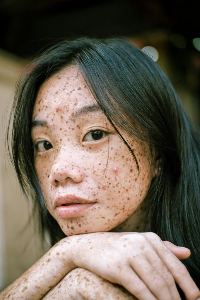 Pimples